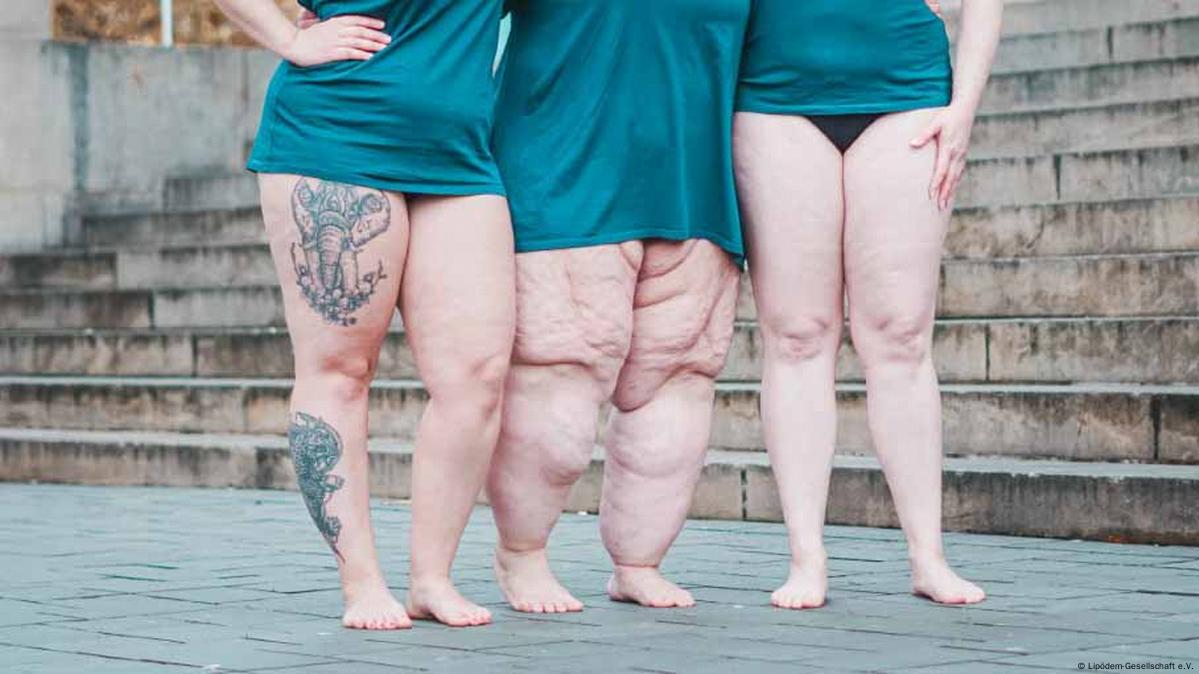 Lipödem-Diagnose: Wie Sie die richtige Behandlung finden