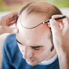 Crafting Your Look: Haartransplantation Türkei Kosten Strategies